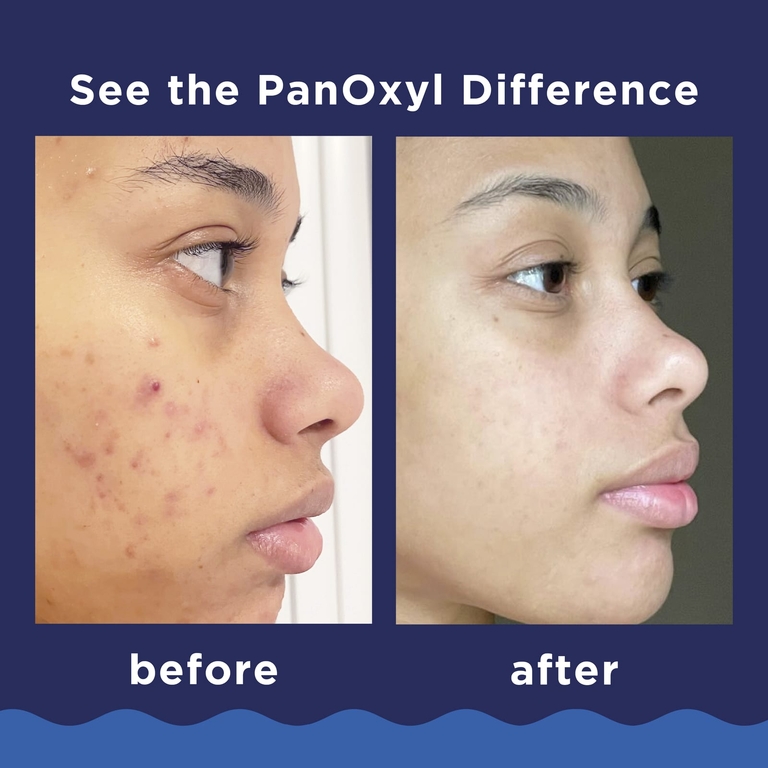 PanOxyl, Пенка для умывания от акне, для лица и тела, максимальная сила действия, 28 г (1 унция)