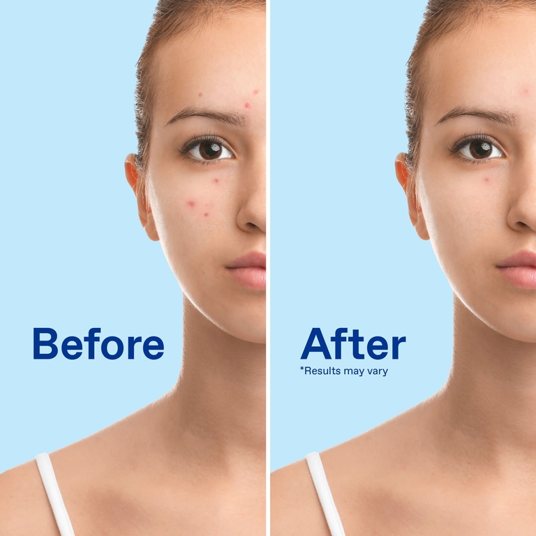 Cetaphil, Differin® пенка для очищения от акне, для лица и тела, 148 мл (5 жидк. унций)